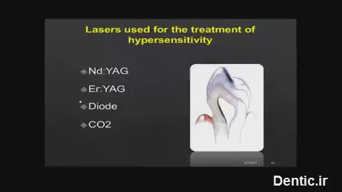 لیزرهایی که برای کاهش حساسیت عاج مورد استفاده قرار میگیرند
