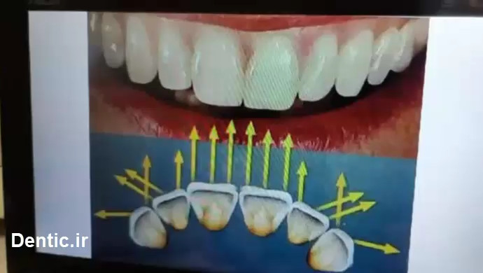 حالت نوردهی دندانها در حالت بیسیک