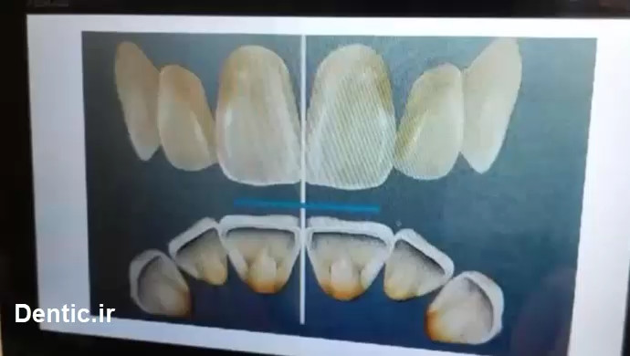 فرم دندانها در ترکیب زیبایی سافت