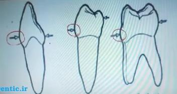 بالج جینجیوالی در تمامی دندانهای قدامی و خلفی در قسمتهای فشیال و لینگوال 