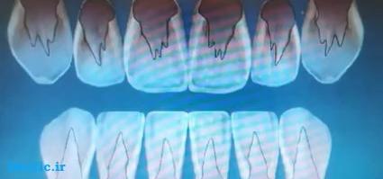 انواع سینگلوم در دندانهای قدامی و خلفی
