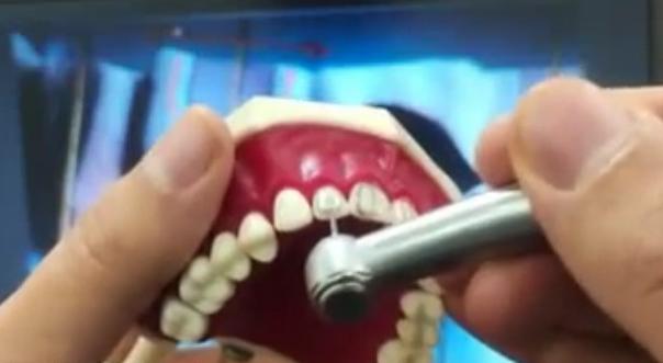 انجام پلن اولیه با فرز روی دندان لترال