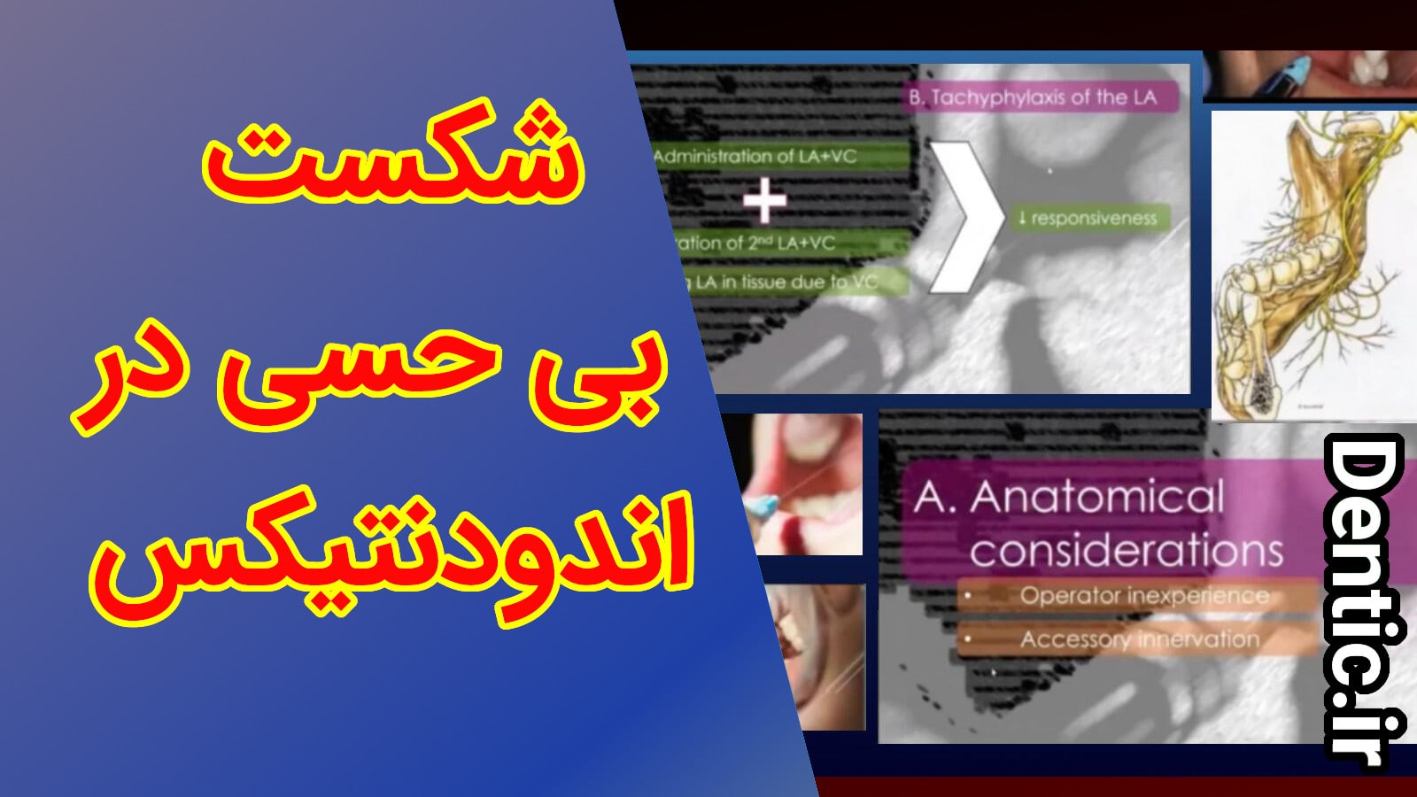 شکست بی حسی در اندودنتیکس