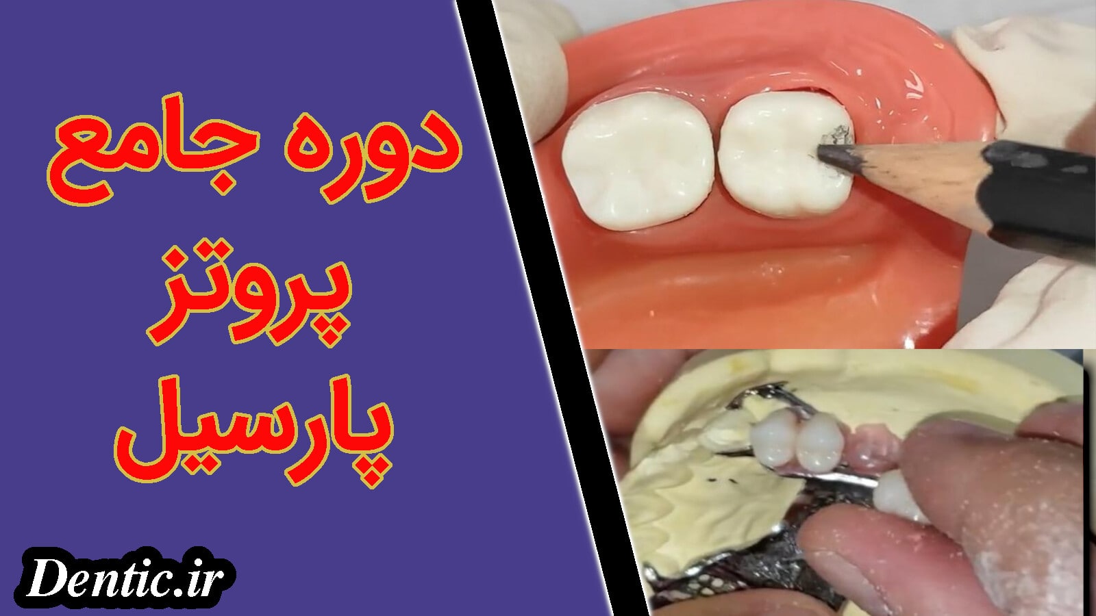 دوره جامع پروتز پارسیل