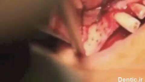 مقدمات پیوند استخوان فک (1)