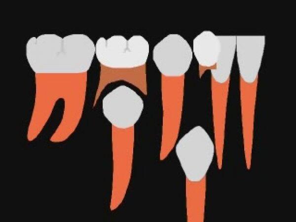 اهمیت کشیدن دندانهای شیری و دائمی در کودکان