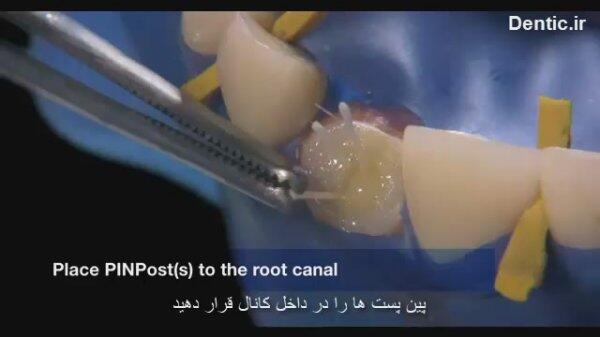 پین پست