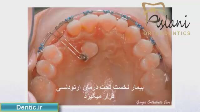 روش ارتودنسی بیمار با دندان نیش نهفته