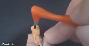 نحوه آماده سازی و چسباندن لمینتها روی دندانها