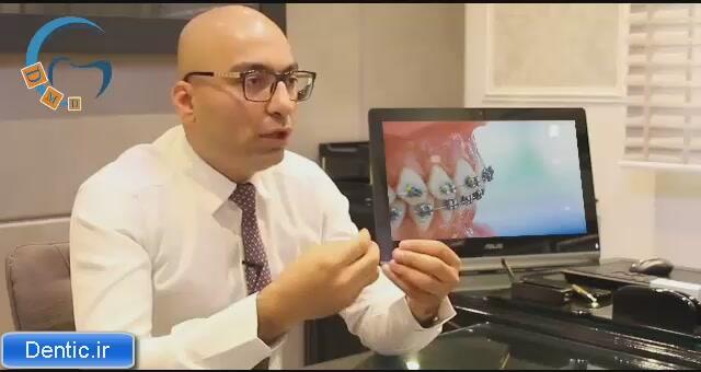 كاربرد ارتودنسي كاموفلاژ