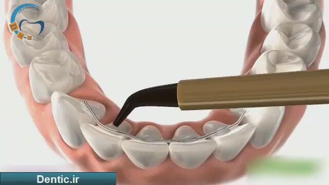 برگشت ارتودنسی