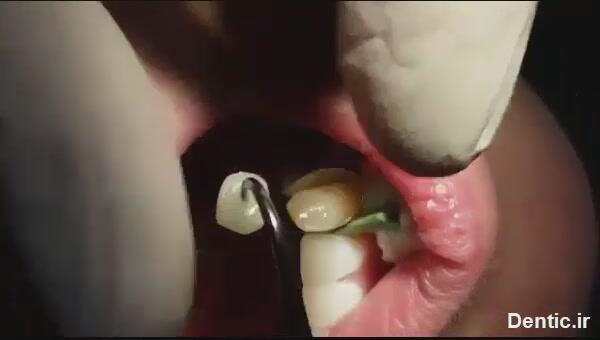 پک کردن کامپوزیت با استفاده از سوند