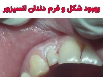 بهبود شکل و فرم دندان انسيزور لترال