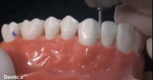 نحوه تراش دادن مینای دندانها و آماده کردن آنها برای چسباندن لمینت