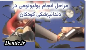 مراحل انجام پولپوتومی در دندانپزشکی کودکان