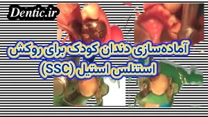 آماده‌سازی دندان کودک برای روکش استنلس استیل (SSC)