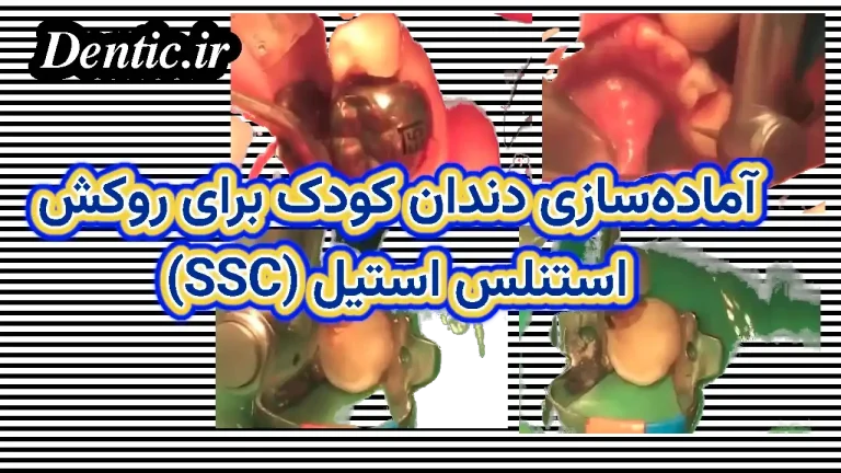 آماده‌سازی دندان کودک برای روکش استنلس استیل (SSC)