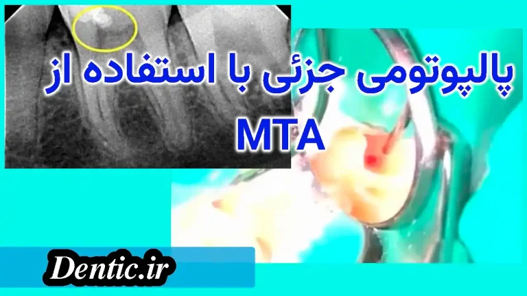 پالپوتومی جزئی با استفاده از MTA