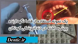 یک نمونه استفاده از فضا نگهدارنده پیش‌ساخته در دندانپزشکی کودکان