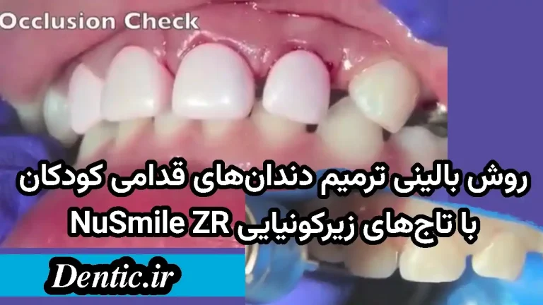 روش بالینی ترمیم دندان‌های قدامی کودکان با تاج‌های زیرکونیایی NuSmile ZR