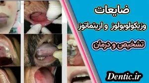 ضایعات وزیکولوبولوز و اریتماتوز - تشخیص و درمان