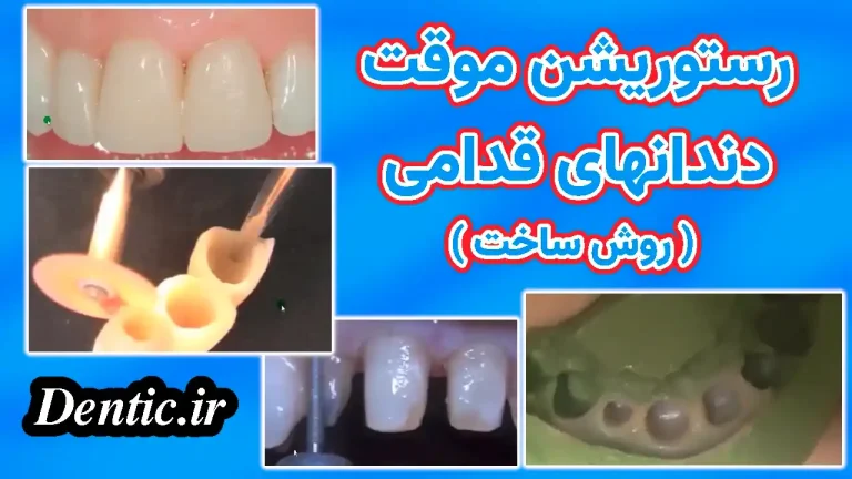 رستوریشن موقت دندانهای قدامی ( روش ساخت )