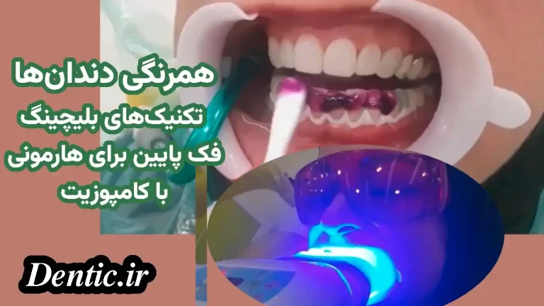 همرنگی دندان‌ها: تکنیک‌های بلیچینگ فک پایین برای هارمونی با کامپوزیت