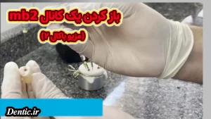 باز کردن یک کانال mb2 (مزیو باکال ۲)